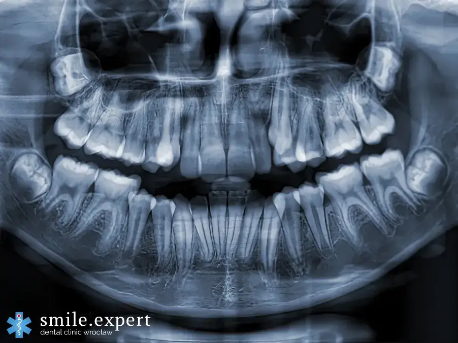 Jak odczytać RTG zęba? Zobacz, co naprawdę widać na zdjęciu