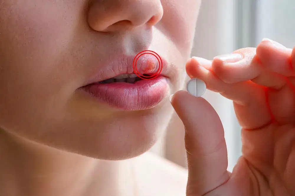 Pryszcz na już? Jak szybko pozbyć się i zapobiec nawrotom