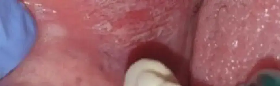 Liszaj w jamie ustnej objawy – poznaj niepokojące sygnały zdrowotne