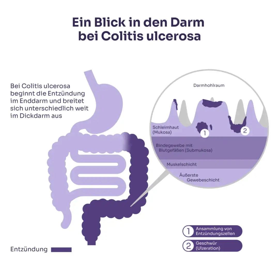 Colitis ulcerosa Symptome: Warnsignale, die Sie nicht ignorieren sollten