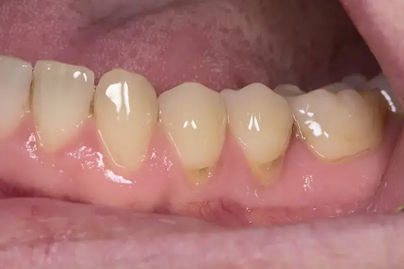 Jak skutecznie leczyć odsłonięte szyjki zębowe i uniknąć bólu – porady i metody