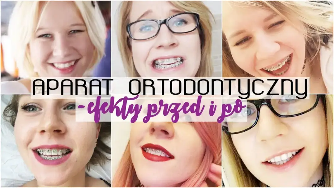 Aparat ortodontyczny a usta: Iluzja czy realna zmiana?