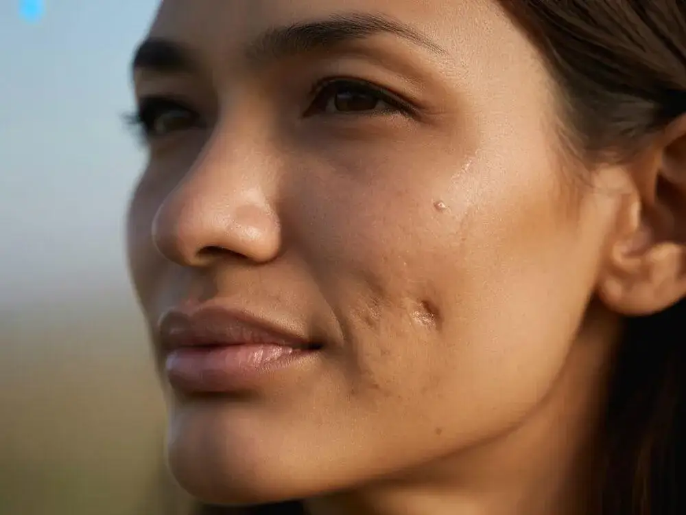 Jak pozbyć się czerwonych śladów po pryszczach? Skuteczny przewodnik