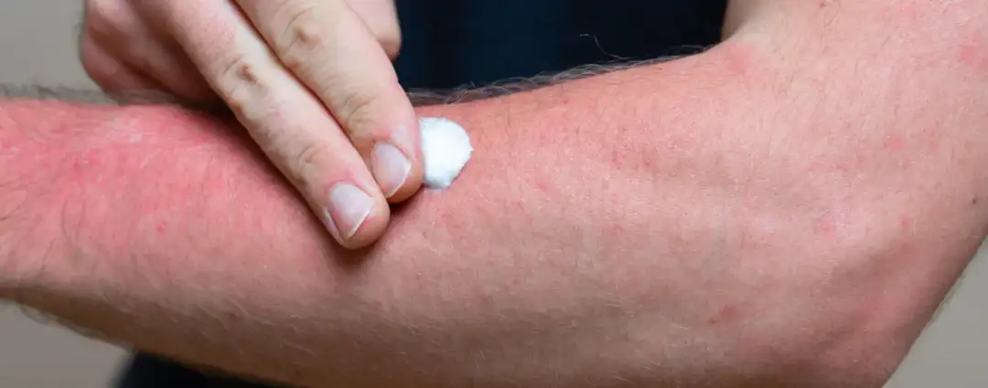 Rote, trockene Haut: Ursachen, Pflege & schnelle Linderung