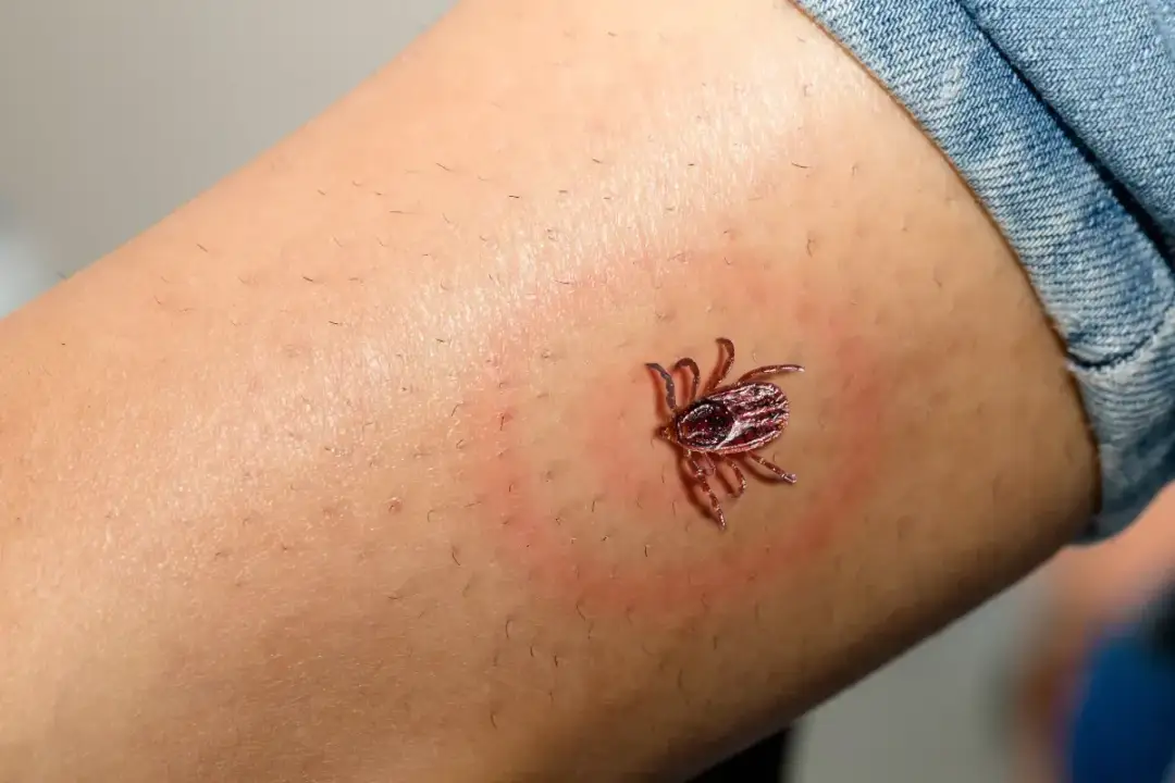 Jak ugryzie kleszcz: co zrobić, aby uniknąć poważnych problemów