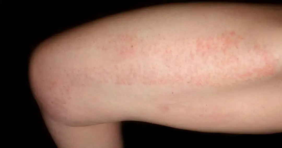 Czerwone kropki po goleniu: przyczyny i skuteczne sposoby na ulgę