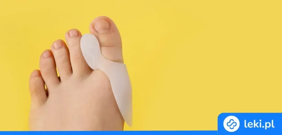 Jak wyleczyć haluksy? Kompleksowy poradnik od ćwiczeń po operację