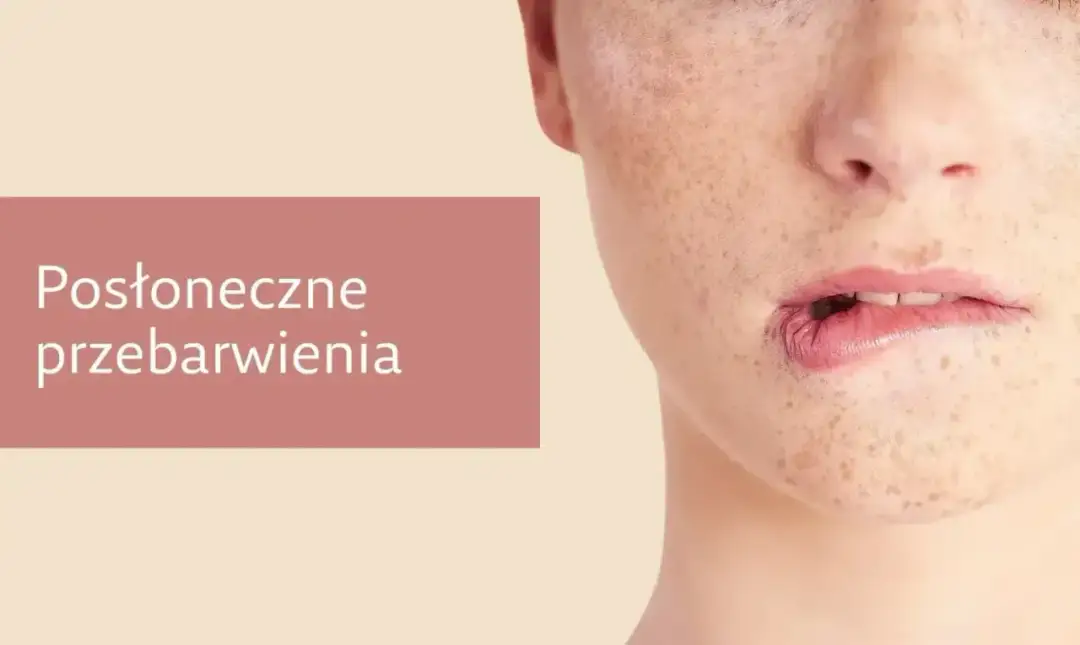 Zbliżenie na twarz z widocznymi przebarwieniami, które mogą być objawem melazmy.