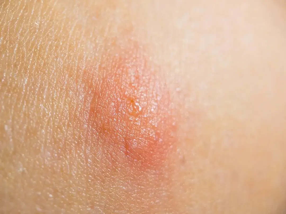 Jak wygląda ugryzienie po kleszczu? Objawy, rumień i zagrożenia boreliozą