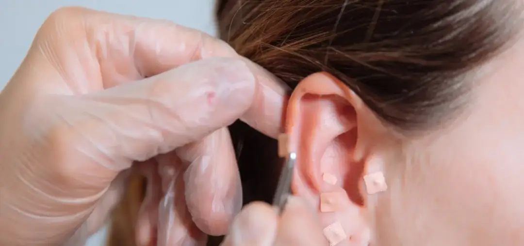 Akupunktura na rzucenie palenia: Czy to działa? Koszty, opinie.