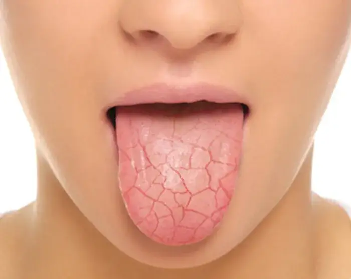 Suchość w jamie ustnej w nocy objawy i przyczyny, które musisz znać