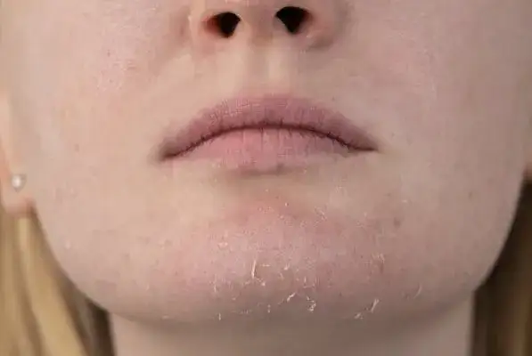 Ile goi się strup po pryszczu? Unikaj błędów w pielęgnacji skóry