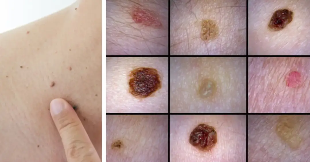 Mały czarny pieprzyk: kiedy powinieneś zgłosić się do lekarza?