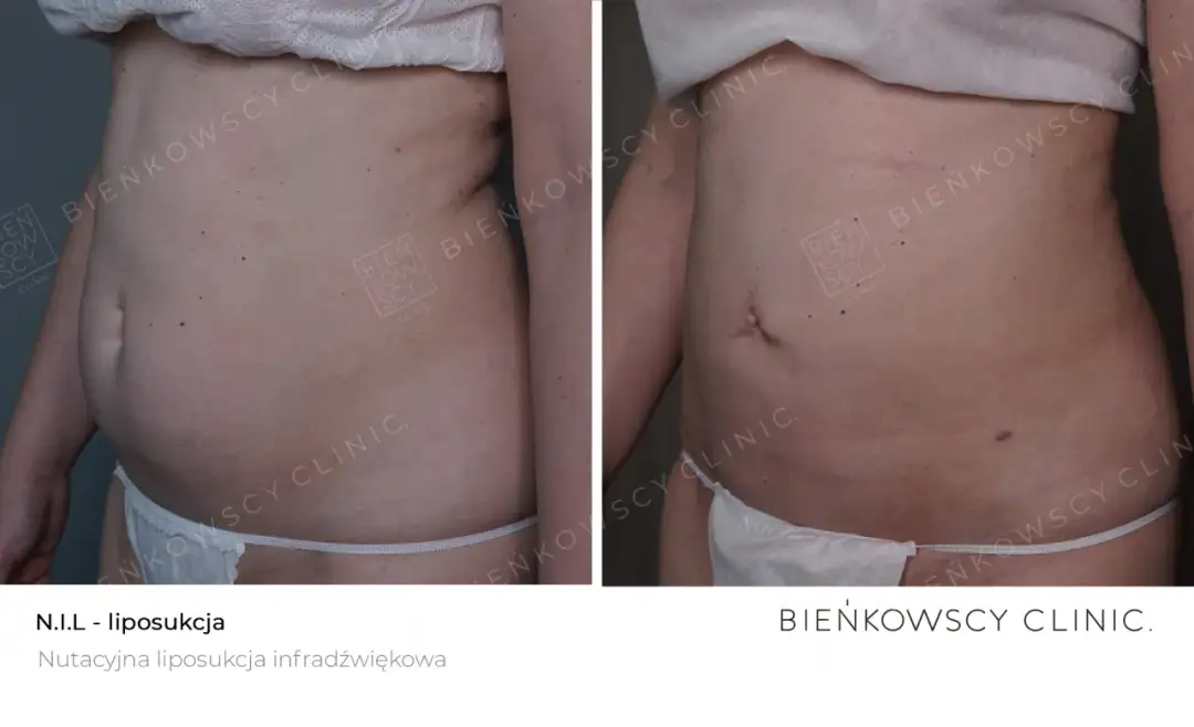 Liposukcja: Co to? Metody, efekty, rekonwalescencja. Czy to dla Ciebie?