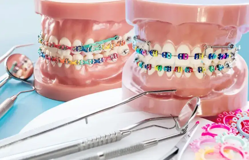 Aparat na zęby: jak działa i ile kosztuje? Kompletny poradnik