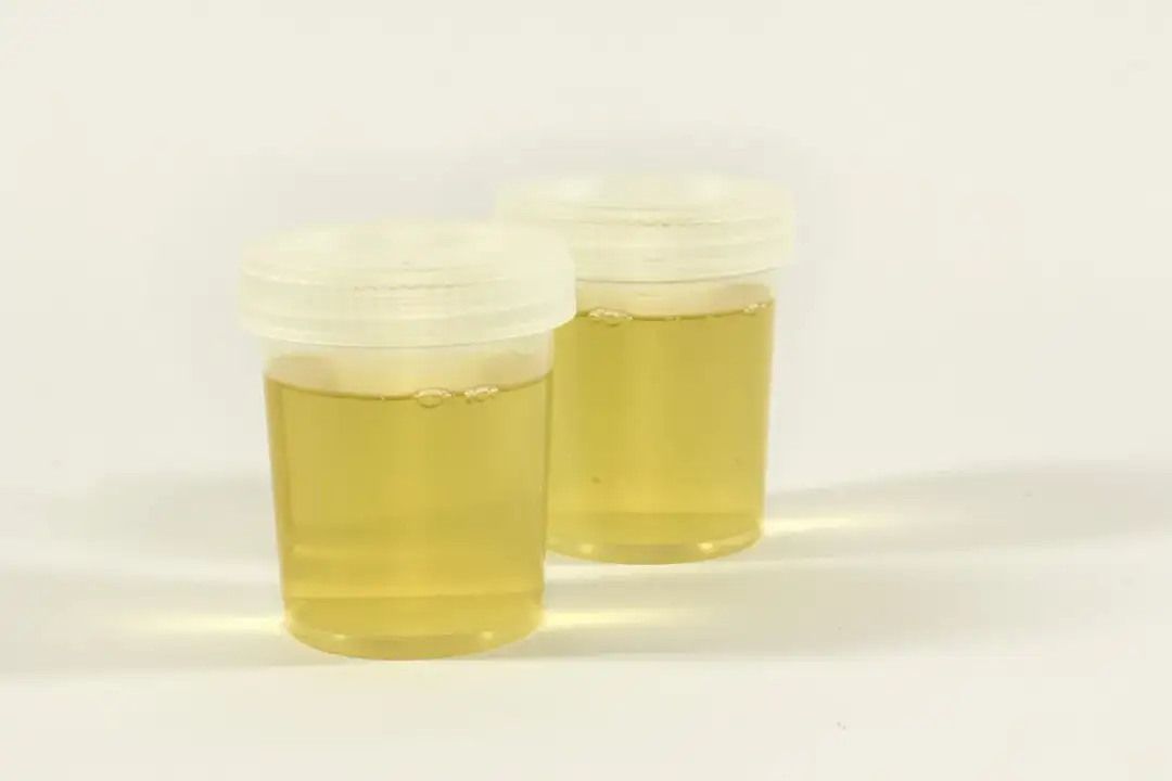 Jak przechowywać mocz przed oddaniem do laboratorium, aby uniknąć błędów