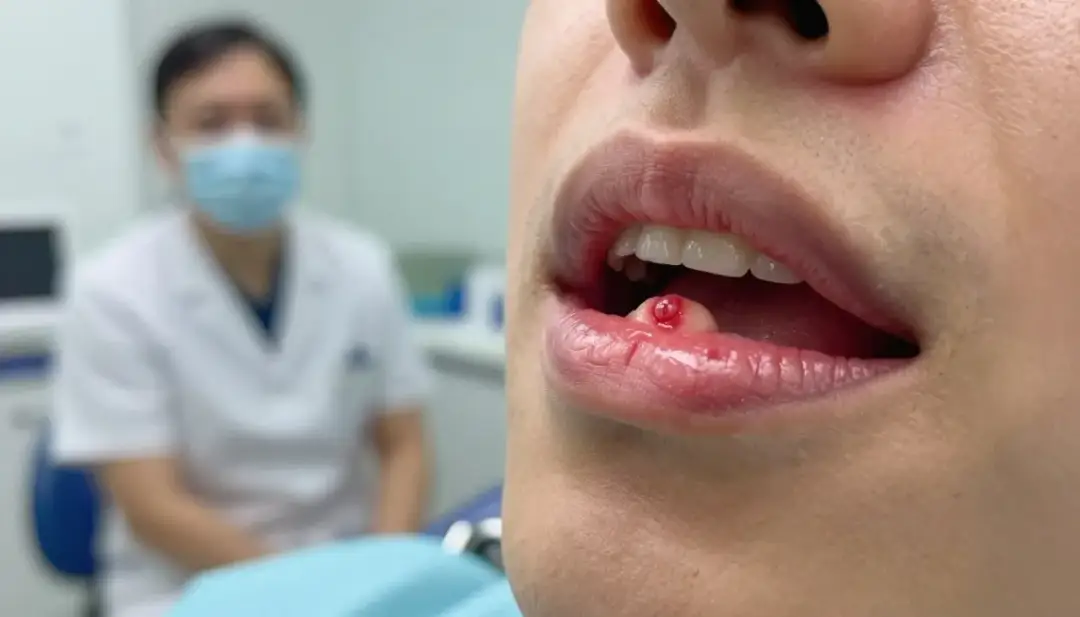 Afta na dziąśle: Skąd się bierze i jak szybko pozbyć się bólu?