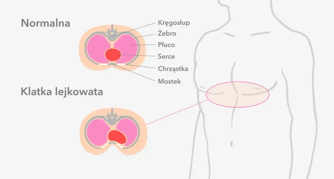 Lejkowata klatka piersiowa – jakiego lekarza potrzebujesz?