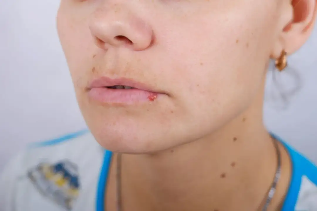 Opryszczka czy pryszcz: jak je odróżnić i uniknąć pomyłek