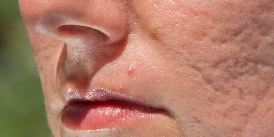 Skąd się biorą pryszcze? Odkryj przyczyny i sposoby na trądzik