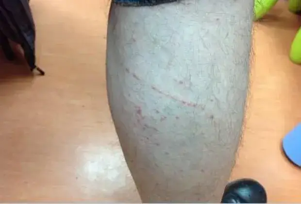 Zjawisko Köbnera: Jak urazy mogą prowadzić do nowych zmian skórnych?