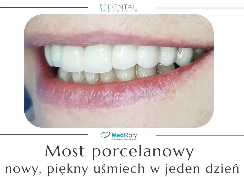 Mostek na zębach: Zobacz, jak wygląda i odzyskaj uśmiech!