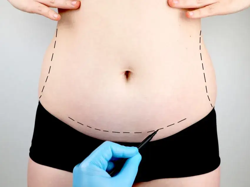 Liposukcja: Przewodnik po odsysaniu tłuszczu. Co musisz wiedzieć?