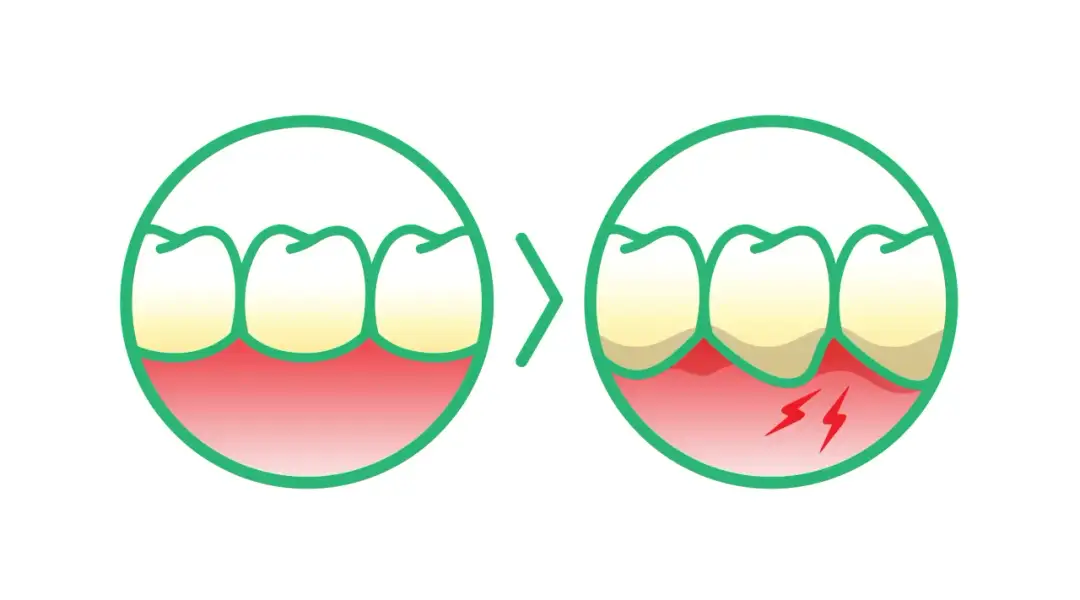 Dlaczego bolą dziąsła? Odkryj przyczyny i skuteczne rozwiązania