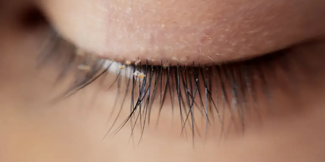 Swędzą Cię rzęsy? To może być nużeniec! Objawy i leczenie.