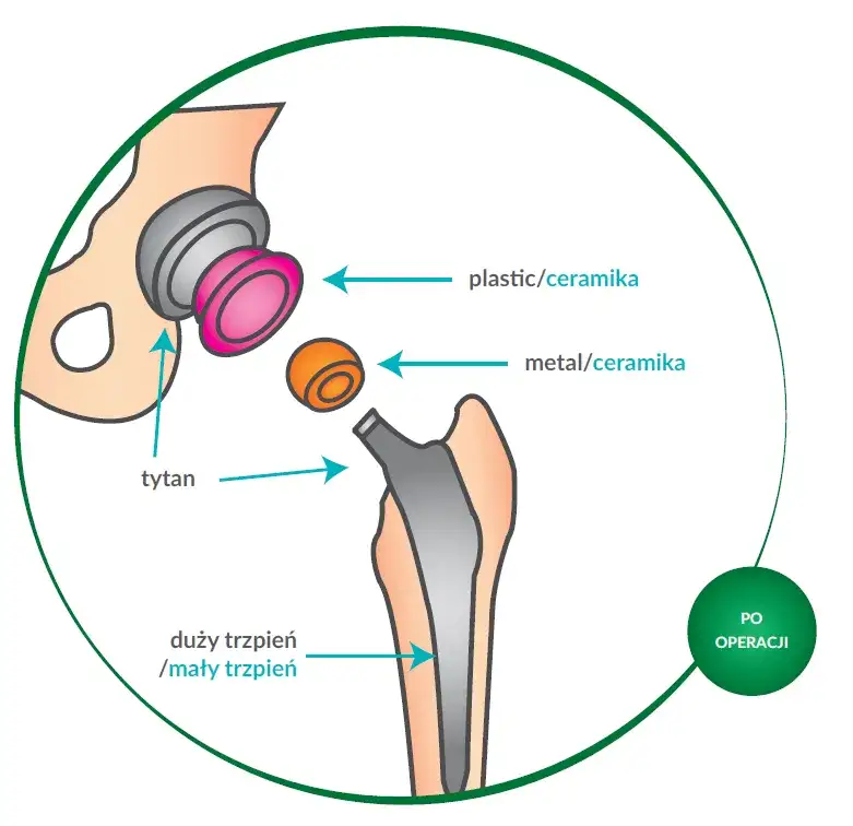 Jakie endoprotezy stawu biodrowego refunduje nfz i co musisz wiedzieć