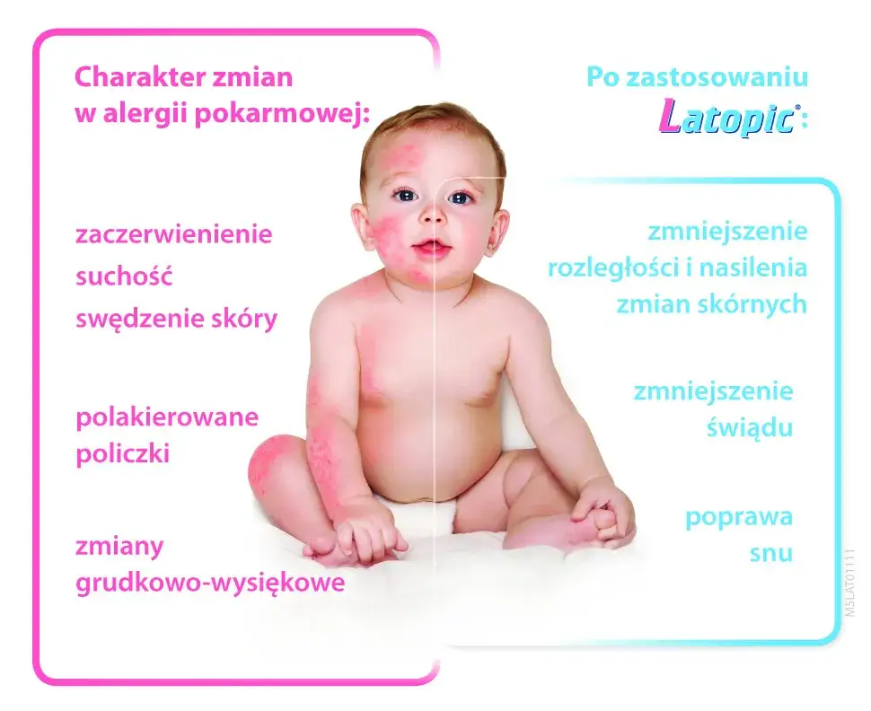 Objawy AZS u niemowlaka: Jak rozpoznać i złagodzić uciążliwe dolegliwości