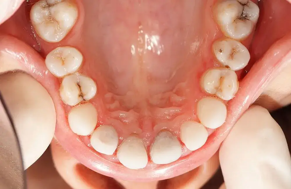 Czy próchnica jest zakaźna? Ochrona dziecka przed bakteriami próchniczymi