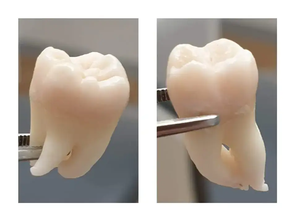 Zęby trzonowe – jakie to zęby i dlaczego są tak ważne dla zdrowia?