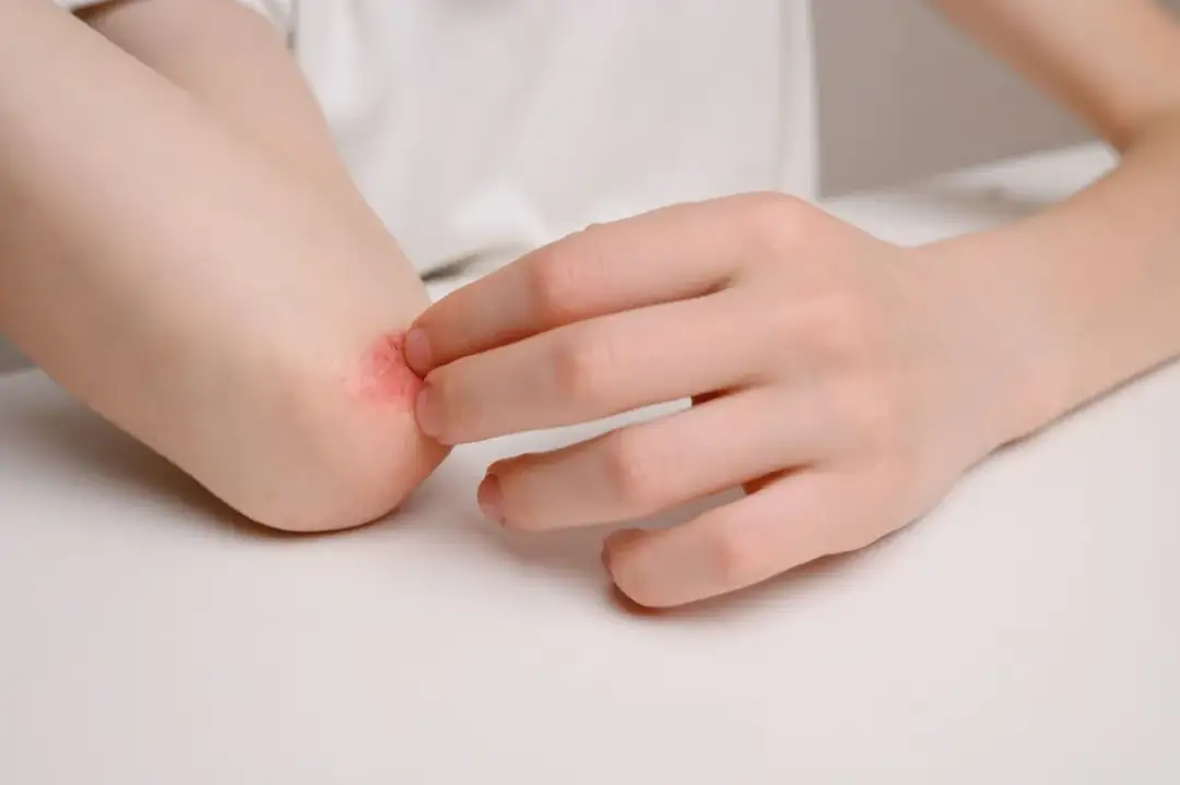 Uczulenie na wieprzowinę: objawy, diagnoza i skuteczne leczenie