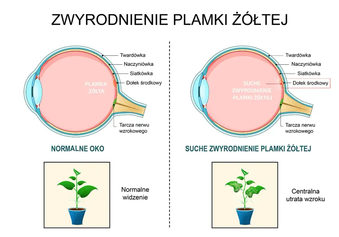 Zwyrodnienie plamki żółtej: objawy, które musisz znać, zanim będzie za późno