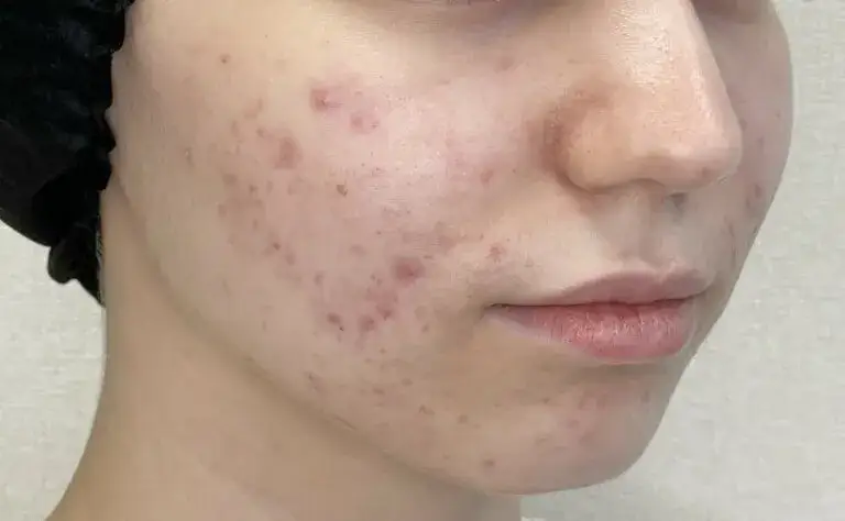 Pryszcze na policzkach: Prawdziwe przyczyny i skuteczne leczenie