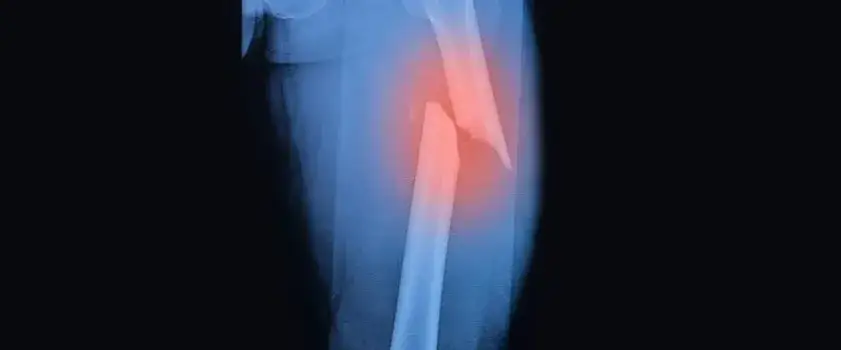 Złamanie kości udowej: ile czasu trwa zrastanie? Poznaj fakty