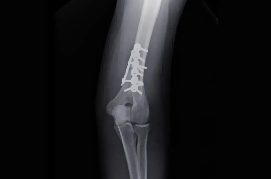 Kiedy zacząć rehabilitację po złamaniu kości ramiennej, aby uniknąć bólu?