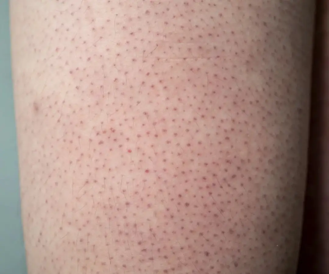 Jak pozbyć się czarnych kropek po goleniu - skuteczne metody i porady