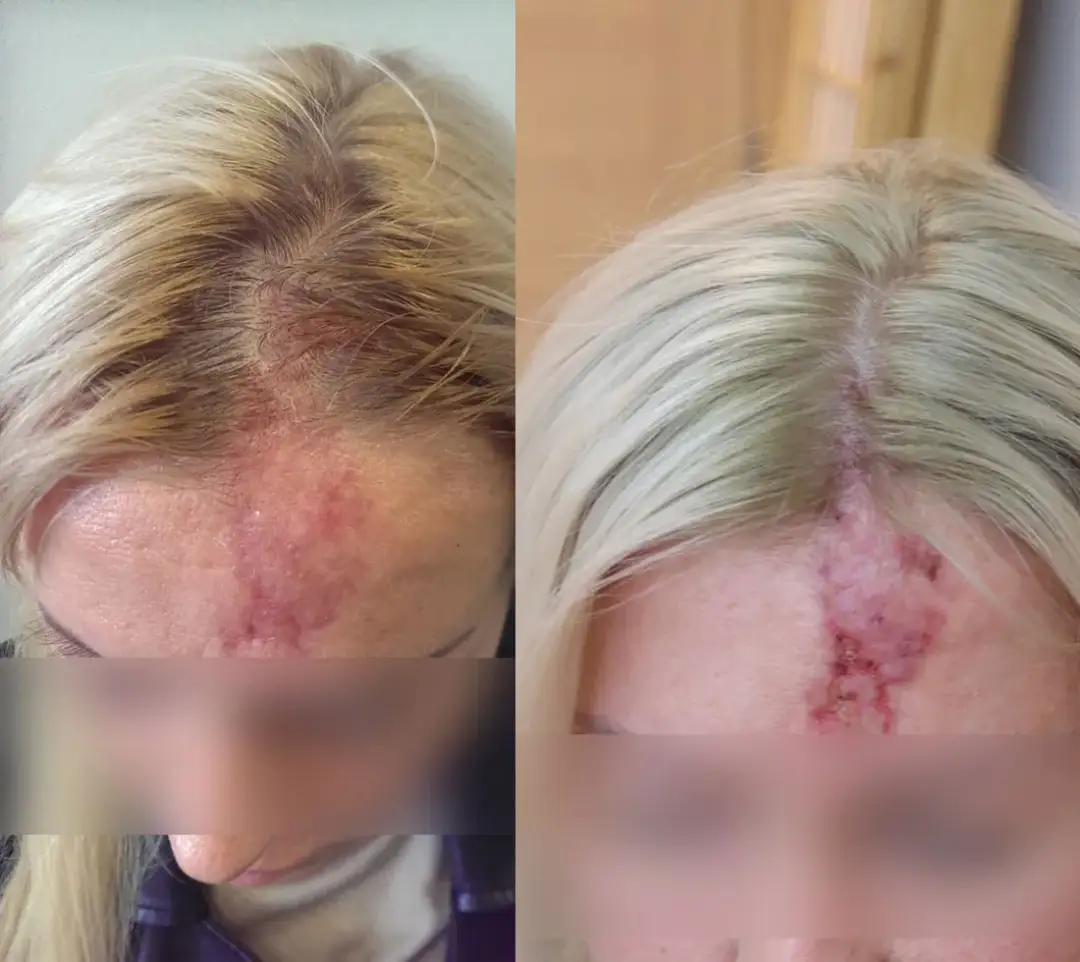 Skutki uboczne kwasu hialuronowego – co powinieneś wiedzieć przed zabiegiem?