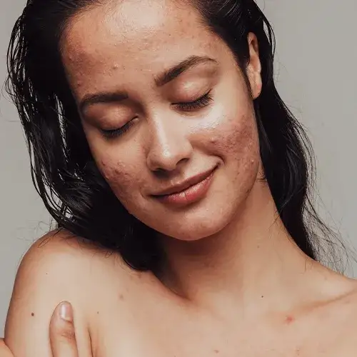 Jak skutecznie poprawić stan cery trądzikowej – sprawdzone metody i porady