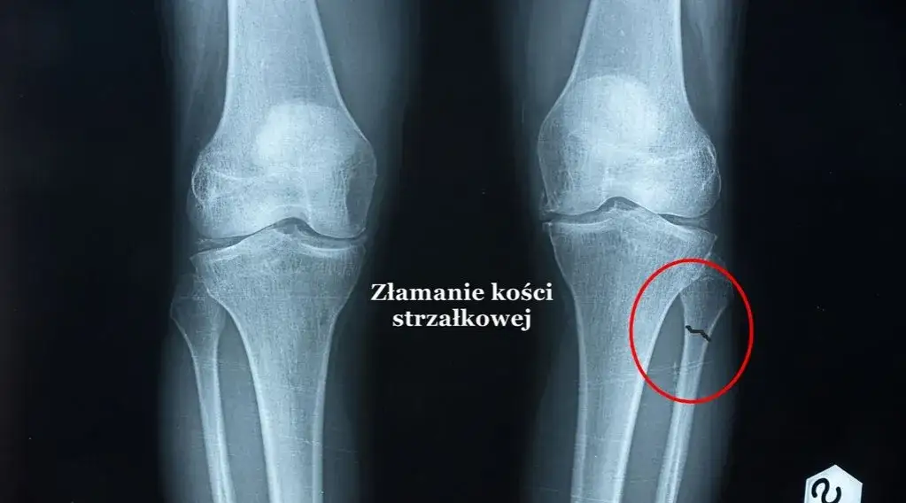 Skuteczne metody na ból po złamaniu – ulga i szybkie leczenie