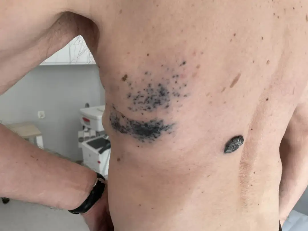 Niepokojące objawy czerniaka - poznaj pierwsze sygnały ostrzegawcze skóry