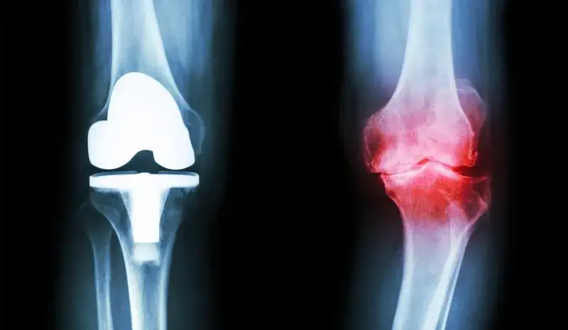 Który lekarz najlepiej leczy zwyrodnienia stawów: poradnik pacjenta