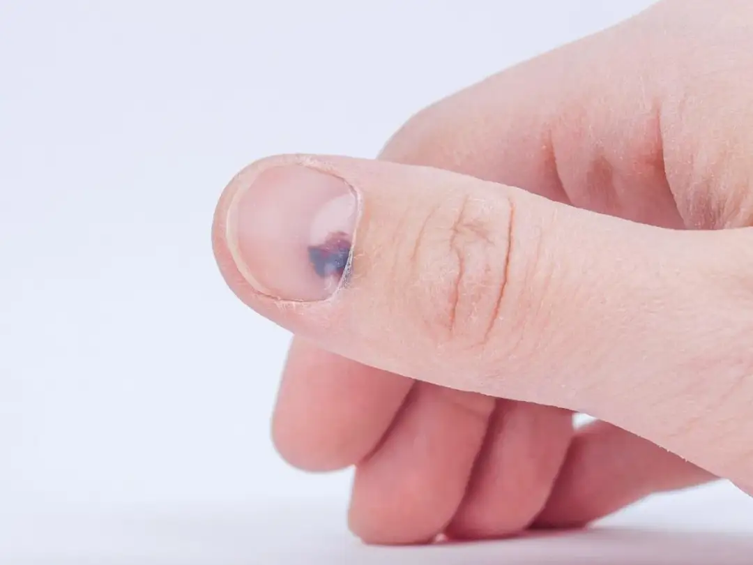 Co oznacza jeden czarny paznokieć? Przyczyny i leczenie