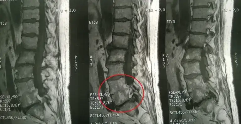 Ile trwa rezonans odcinka lędźwiowego? Poznaj czas i przebieg badania