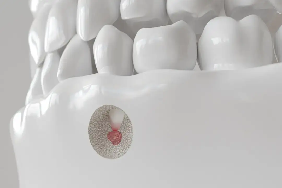 Ile kosztuje usunięcie korzenia zęba? Sprawdź, co wpłynie na cenę