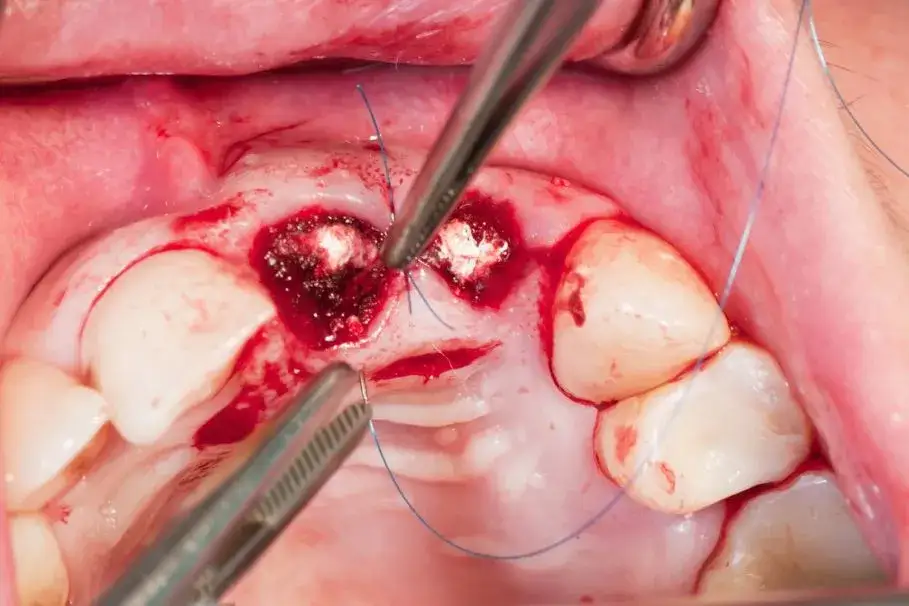 Kiedy zakłada się szwy po wyrwaniu zęba? Ważne informacje dla pacjentów