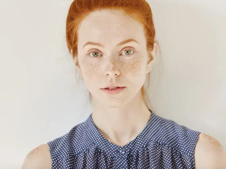 Jak wybielić piegi na twarzy: Skuteczne metody domowe i profesjonalne