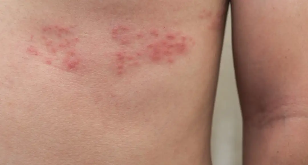 Czerwona plama pod piersią: Jak leczyć czerwoną plamę pod piersią?